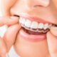 clear aligners