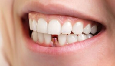 dental implants