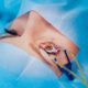 laser cataract surgery