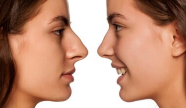 nose jobs