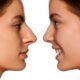 nose jobs
