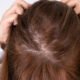 understanding the early signs of hair thinning
