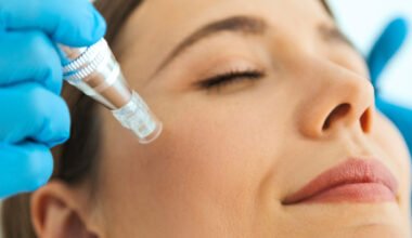 undergoing rf needling treatment