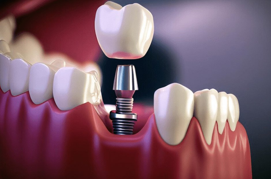 jawbone health influences your tooth replacement success